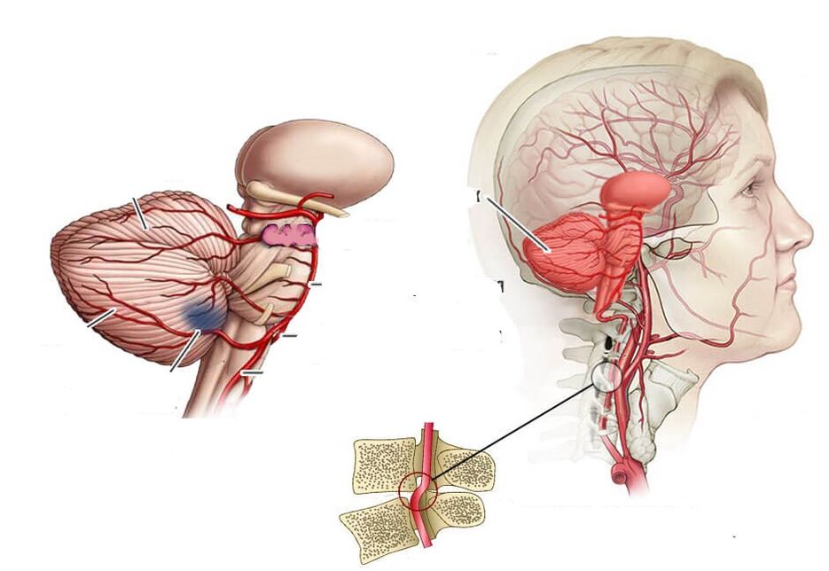 Serebellar ishemiyasi